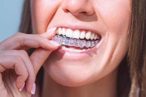 invisalign cost Massachusetts | woman holding aligner