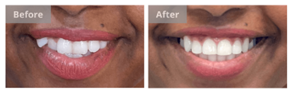 invisalign before and after 6 months | dedham dentist