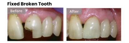 broken tooth before and after photo | cosmetic dentist dedham