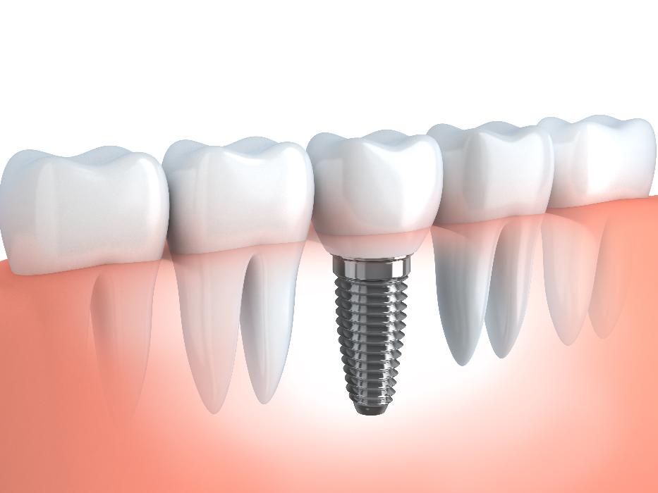 dental implants dedham