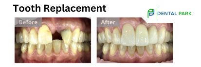 tooth replacement near me | before and after missing tooth