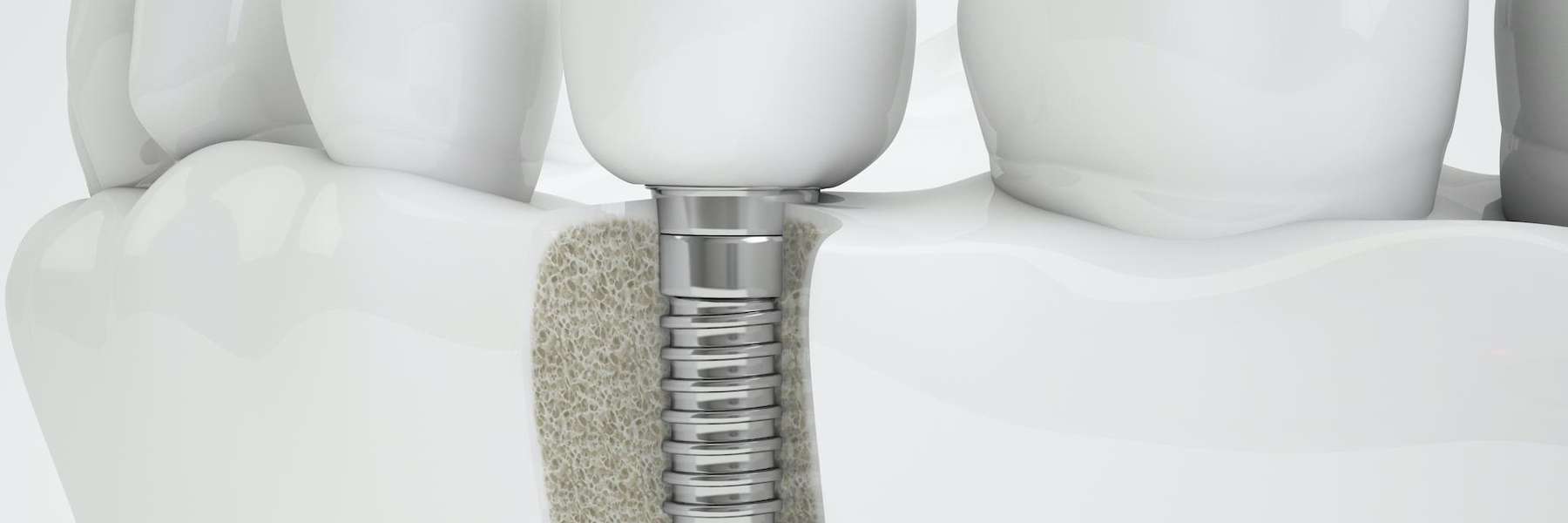 dental implants dedham