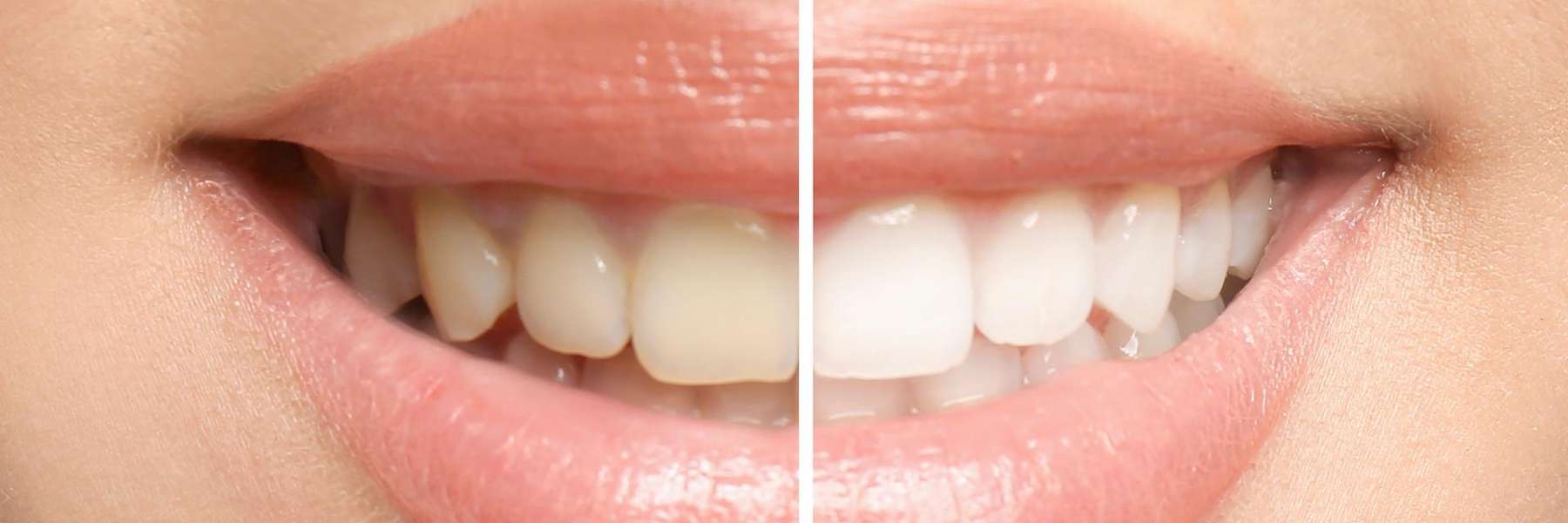 teeth whitening dedham | before and after whitening