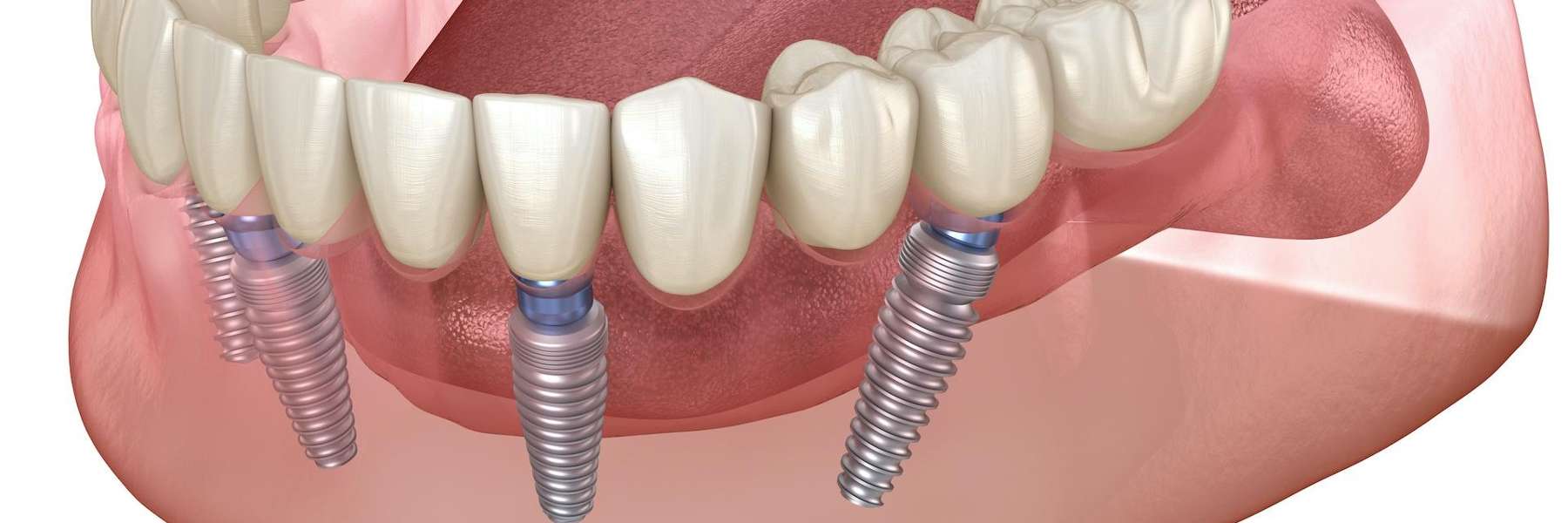 tooth extractions dedham | image of dental implants