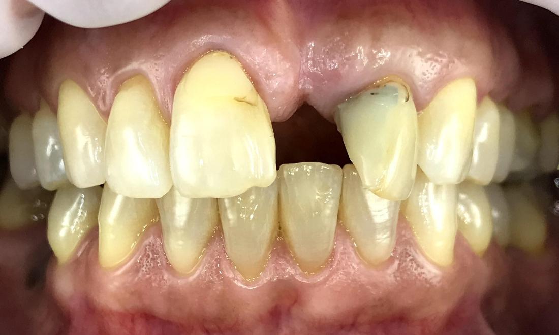 before photo missing tooth | tooth replacement dedham