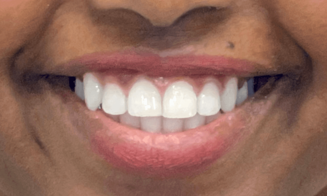 Invisalign results after 6 months | Dedham, MA