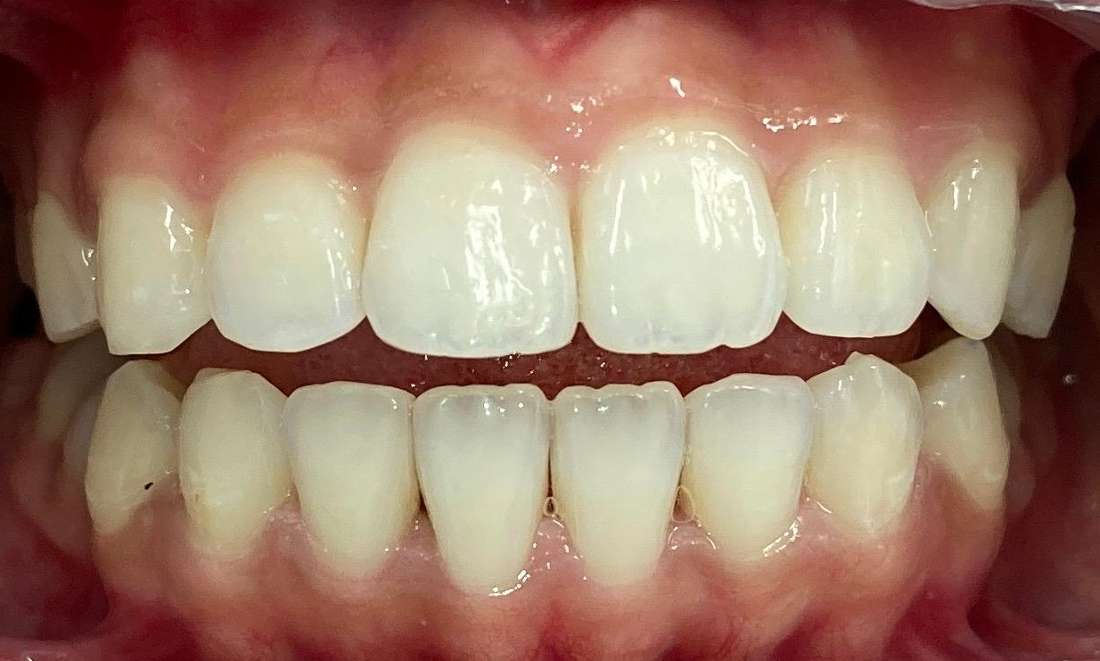 Patient with new smile from Invisalign Dedham