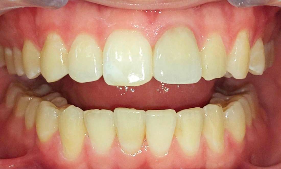 Patient with new smile after Invisalign photo