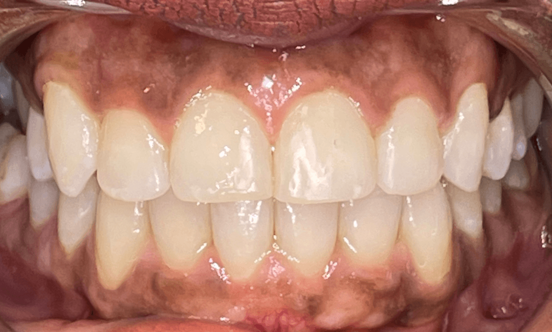 woman with new bite from Invisalign in Dedham MA