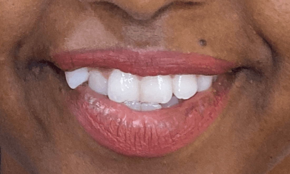 Woman with crooked teeth | Dedham Dentist