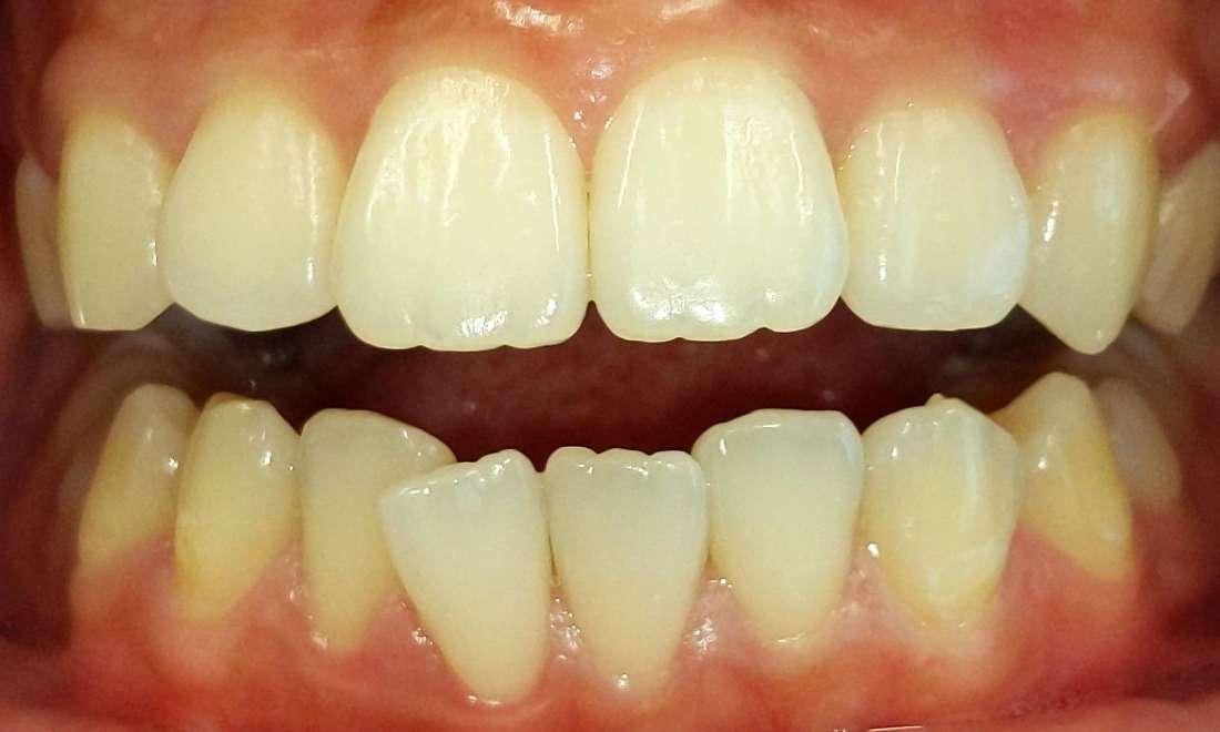 Patient before photo Invisalign Dedham